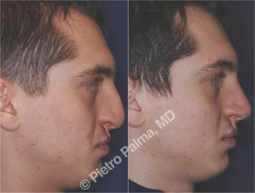 rhinoplasty before and after special cases men