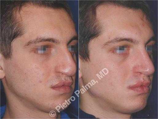 rhinoplasty before and after special cases men 1