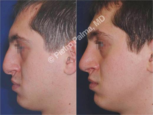 rhinoplasty before and after special cases men 2