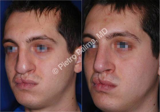 rhinoplasty before and after special cases men 3