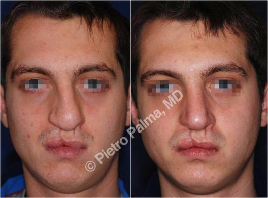 rhinoplasty before and after special cases men 4