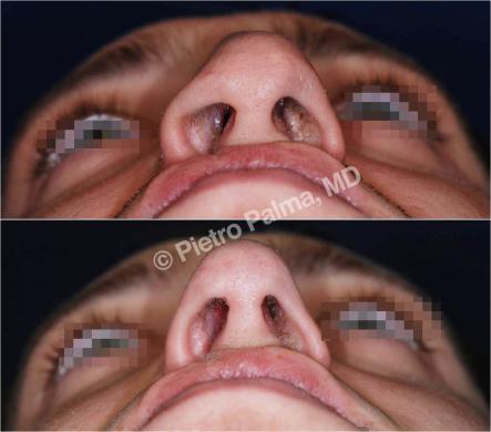 rhinoplasty before and after special cases image 2