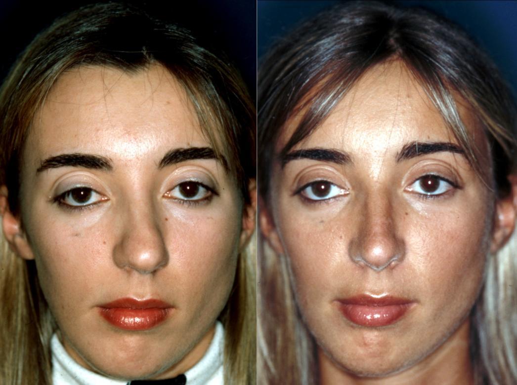 Halle Berry Nose Job Before After Deviated Septum Inf vrogue.co