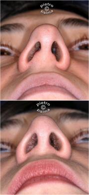 Twisted nose / Naso deviato