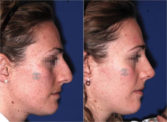 reduction rhinoplasty before and after