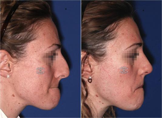 reduction rhinoplasty before and after 1