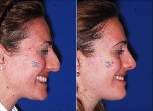 nose reduction before and after