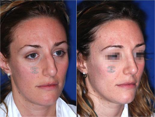 big nose rhinoplasty before and after