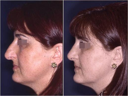 nose job before and after special cases