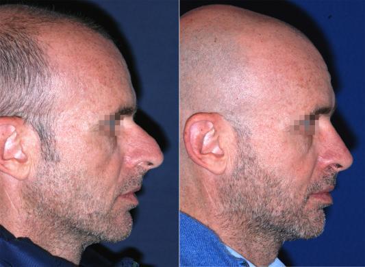 mens nose job before and after 1