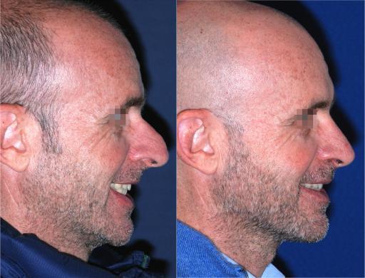 mens nose job before and after 2