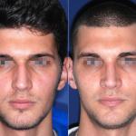 rhinoplasty male before and after