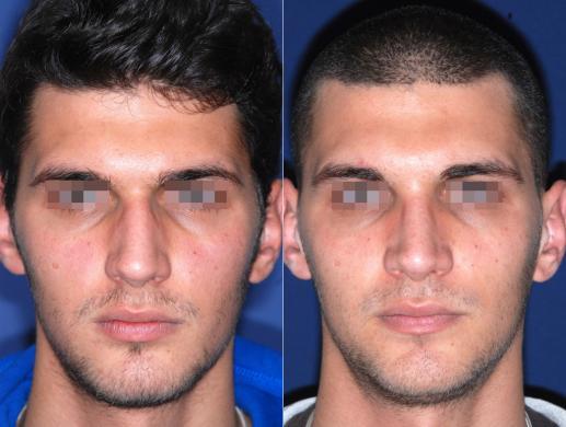 rhinoplasty male before and after
