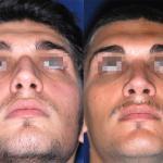 rhinoplasty male before and after 1
