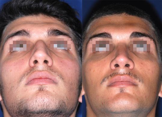 rhinoplasty male before and after 1