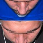 rinoplastica uomo prima e dopo 1