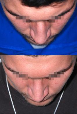 rhinoplasty male before and after 2