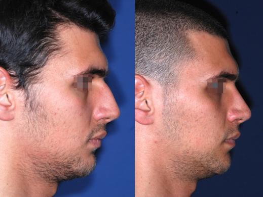 rhinoplasty male before and after 8