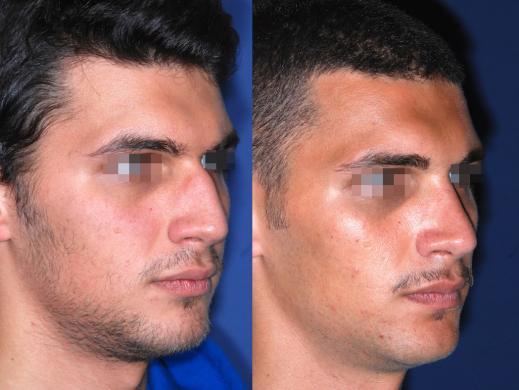 rhinoplasty male before and after 7