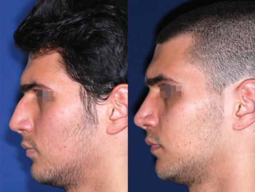 rhinoplasty male before and after 6