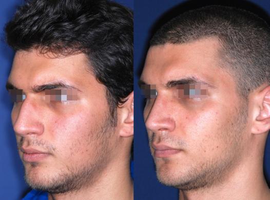 rhinoplasty male before and after 3