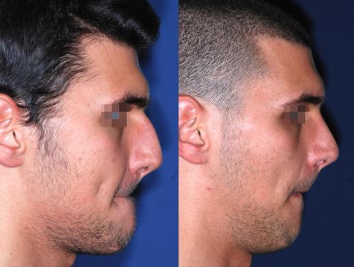 rhinoplasty male before and after 4