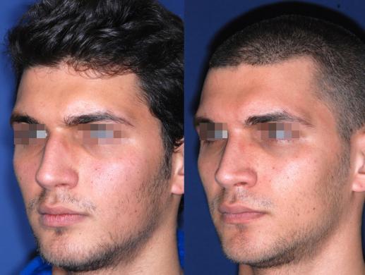 rhinoplasty male before and after 5