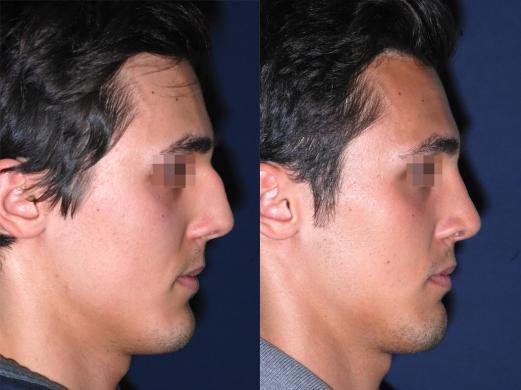 before and after rhinoplasty male