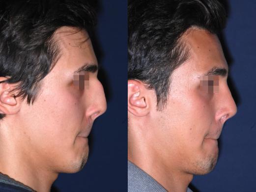 before and after rhinoplasty male 1