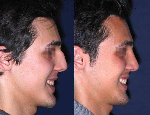 before and after rhinoplasty male 2