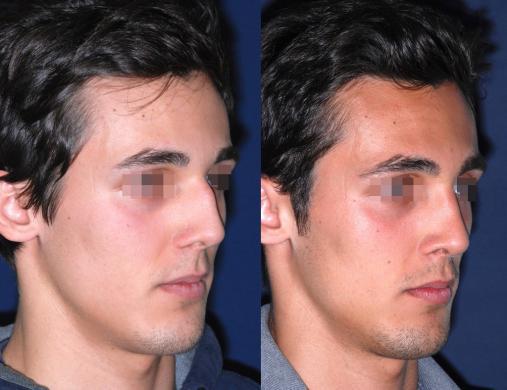 before and after rhinoplasty male 3