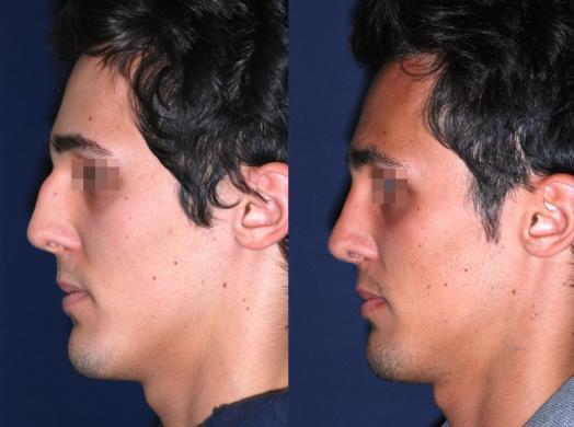 before and after rhinoplasty male 5