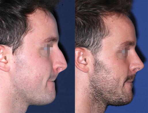 rhinoplasty men