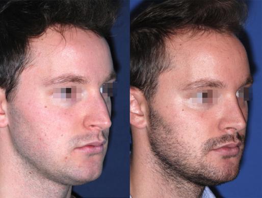 rhinoplasty men 2