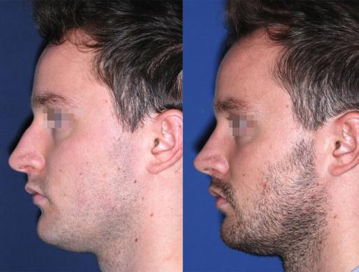 rhinoplasty men 3