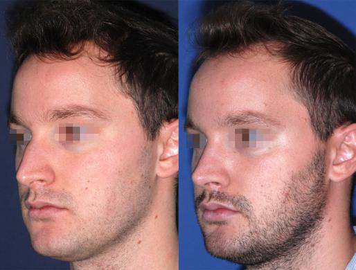 rhinoplasty men 4