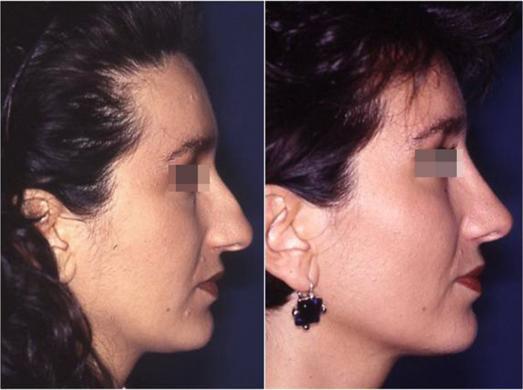 nose job before and after special cases 1