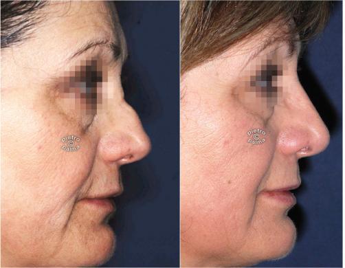 nose job revision 3