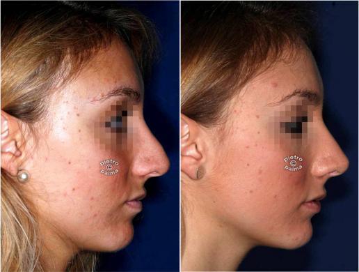 revision rhinoplasty before and after