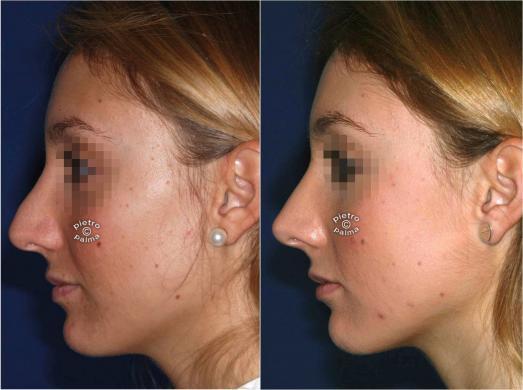 revision rhinoplasty before and after 1
