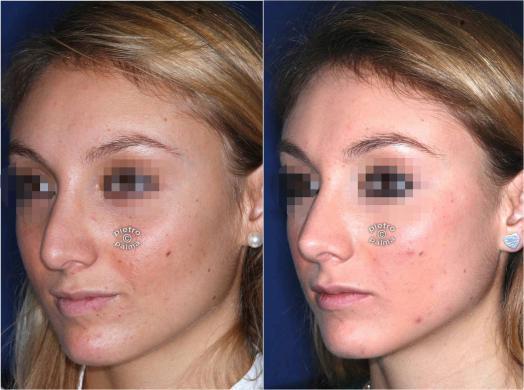 revision rhinoplasty before and after 2