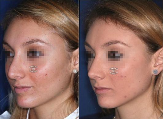 revision rhinoplasty before and after 3