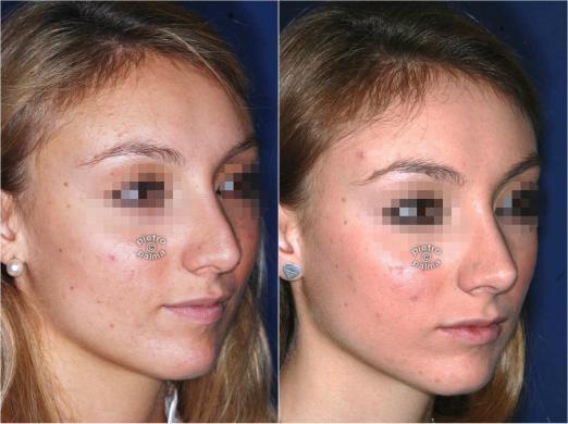 revision rhinoplasty before and after 4