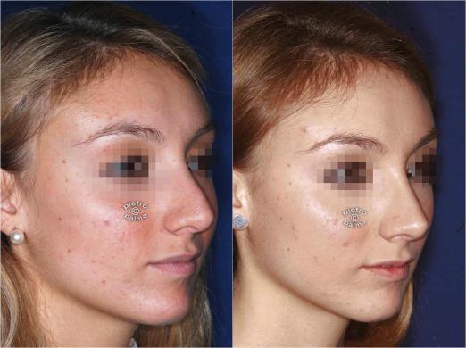 revision rhinoplasty before and after 5