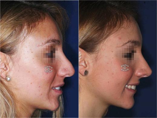 revision rhinoplasty before and after 6