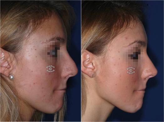 revision rhinoplasty before and after 7