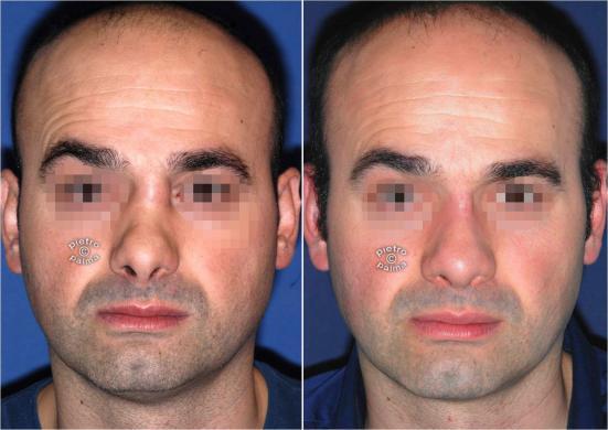 revision rhinoplasty before and after man