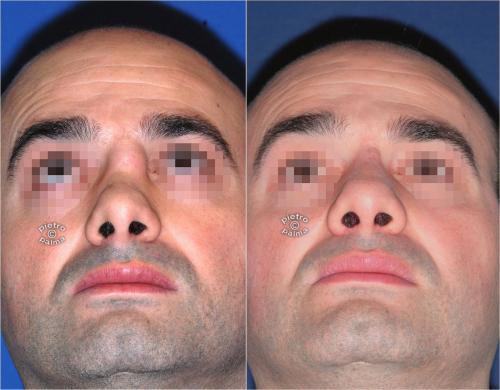 revision rhinoplasty before and after man 1