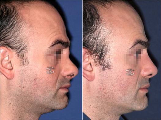 revision rhinoplasty before and after man 2