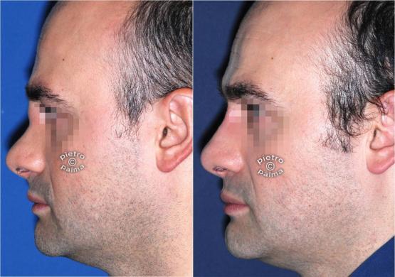 revision rhinoplasty before and after man 3